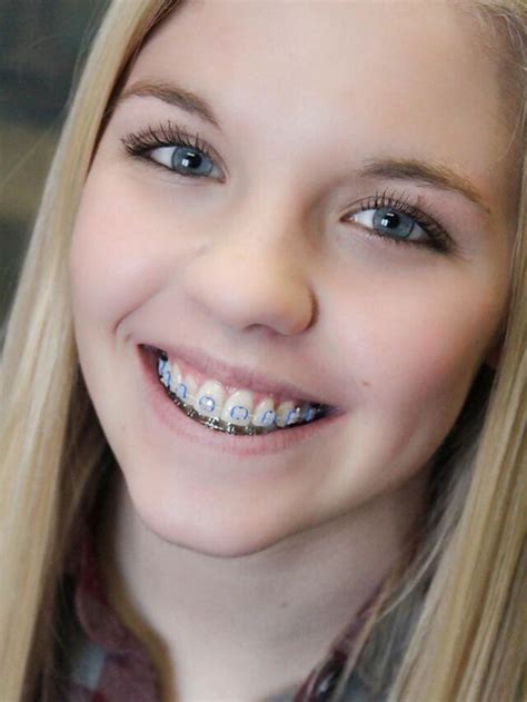 Browse Getty Images' premium collection of high-quality, authentic Teenagers In Bras stock photos, royalty-free images, and pictures. . Teen braces nude